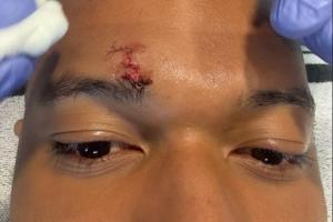 给姆总整破相了!姆巴佩晒脸部受伤近距离特写,眉骨缝了好几针